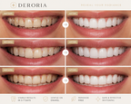 Deroria whitening before and after